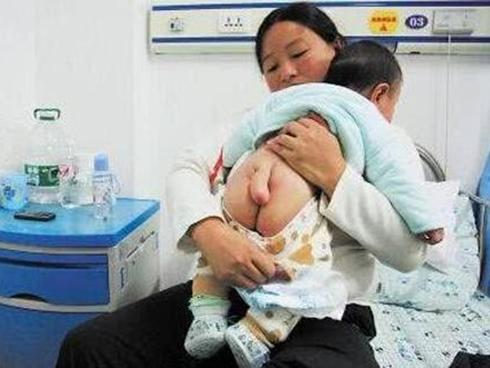 Sinh ra con có cục thịt thừa, mẹ không ngờ 5 tháng sau con 'mọc đuôi' dài đến 5cm