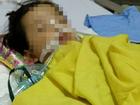 Bé gái 20 tháng tuổi bị rạn hộp sọ, hôn mê sâu, liệt nửa người sau khi đến trường mầm non 3 ngày