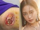 Sao Hàn 23/4: Shock nặng với vết thương lở loét của 'Mỹ nữ tái sinh' Han Ye Seul