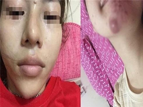 Làm đẹp bằng phương pháp tiêm filler: Cẩn thận 'tiền mất, tật mang' khi ham giá rẻ