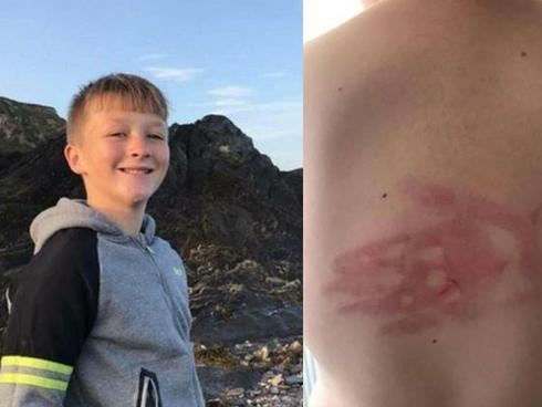 Người mẹ chết lặng khi biết sự thật đằng sau dấu tay in hằn trên lưng con trai