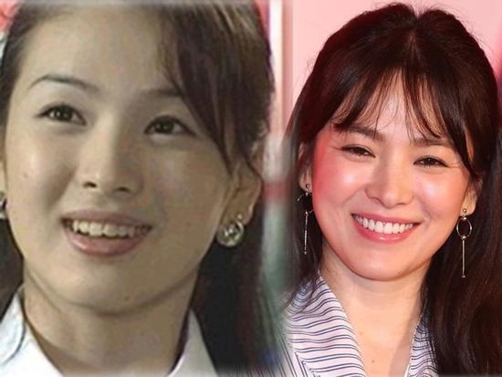 Không riêng gì Song Hye Kyo, nhiều Sao cũng thành mỹ nhân nhờ chỉnh răng
