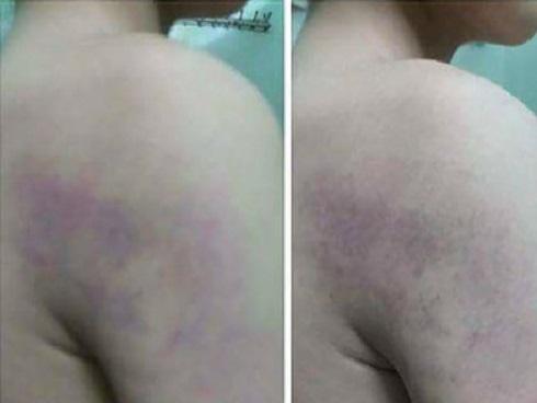 Hà Nội: Giáo viên bị tố đánh học sinh lớp 1 bầm tím