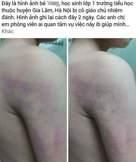 Hình ảnh một em học sinh lớp 1 Trường Tiểu học Kiêu Kỵ, Gia Lâm, Hà Nội bị thâm tím cơ thể do cô giáo bạo hành gây phẫn nộ. Theo lời kể của mẹ học sinh, hai vợ chồng chị phát hiện con trai bị bầm tím khi tắm cho con vào ngày 2/5. Sau đó, cô giáo đã gửi lời xin lỗi tới gia đình học sinh và nhà trường cũng đã mời phụ huynh lên làm việc.