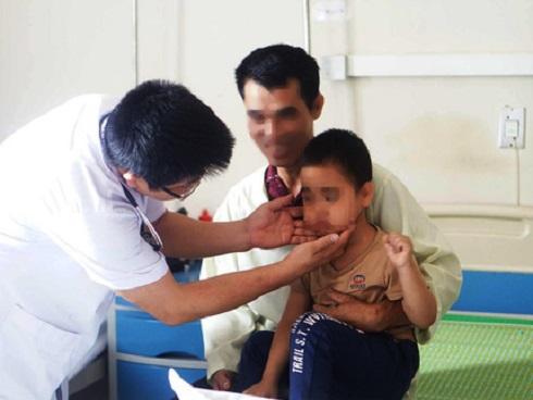 Cảnh báo việc lạm dụng thuốc corticoid: Một bé trai ở Sơn La nhập viện Nội tiết Trung ương trong tình trạng béo phì, mặt nặng, mọc lông và rậm lông vùng mặt và mép sau khi được tiêm corticoid 4 ngày liên tục, mỗi ngày 2 mũi không rõ liều lượng. Theo chẩn đoán của bác sĩ, bệnh nhi có triệu chứng lâm sàng của hội chứng suy tuyến thượng thận do sử dụng corticoid quá liều và không đúng chỉ định.
