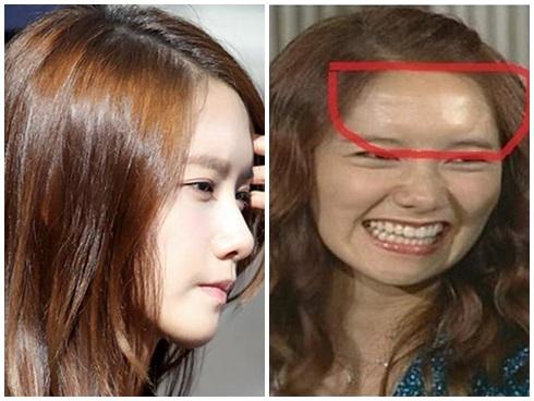 Yoona (SNSD) cũng để lộ vết tích của miếng silicon độn trán của mình mỗi khi cười hay nhăn mặt.