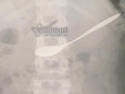 Uống cà phê, cô gái nuốt chửng thìa vào bụng