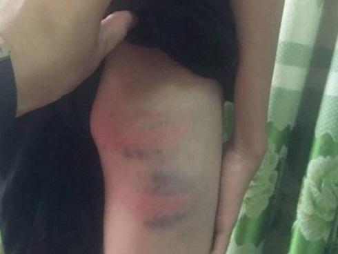 Nghi vấn bé trai 12 tuổi bị mẹ kế đánh đập gây thương tích nặng phải nhập viện