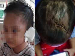 Bé 3 tuổi nghi bị mẹ và 'cha dượng' bạo hành
