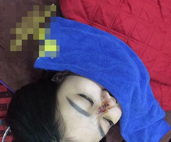 Sau khi biết bị phẫu thuật "lỗi", cô gái này tìm để chủ thẩm mỹ tên P.P.A sinh năm 2001 thì bị chối bỏ trách nhiệ. Người này cho rằng, nạn nhân không chịu uống thuốc theo chỉ định nên mới dẫn tới hậu quả như vậy.