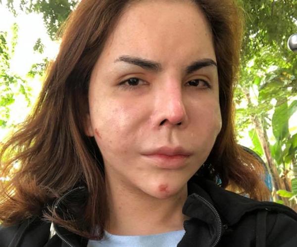 Theo đó, cô nàng bị biến dạng gương mặt sau khi phẫu thuật nạo silicon, chiếc mũi bị quặp xuống, khuôn mặt thì càng ngày càng méo mó,...