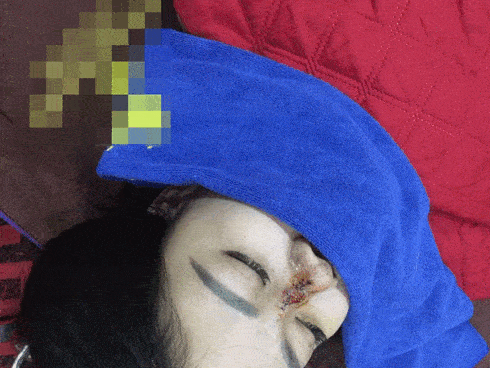 Phát hoảng với môi 'trái tim', mũi hoại tử vì phẫu thuật thẩm mỹ hỏng