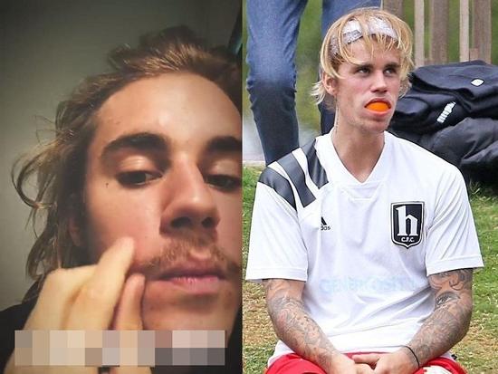 Nuôi râu xồm xoàm, tóc dài bẩn thỉu, hồn nhiên nặn mụn... 'Hoàng tử' Justin Bieber khiến giới yêu nhạc hoảng sợ