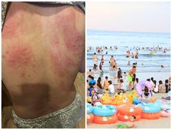 Xét nghiệm nước, tìm nguyên nhân khiến du khách nổi mẩn đỏ và ngứa sau khi tắm biển Đà Nẵng