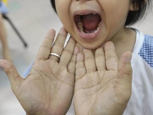 Bác sĩ ám ảnh bệnh nhi bị mủn hết xương hàm, miệng bốc mùi vì kiêng cữ khi mắc sởi-3
