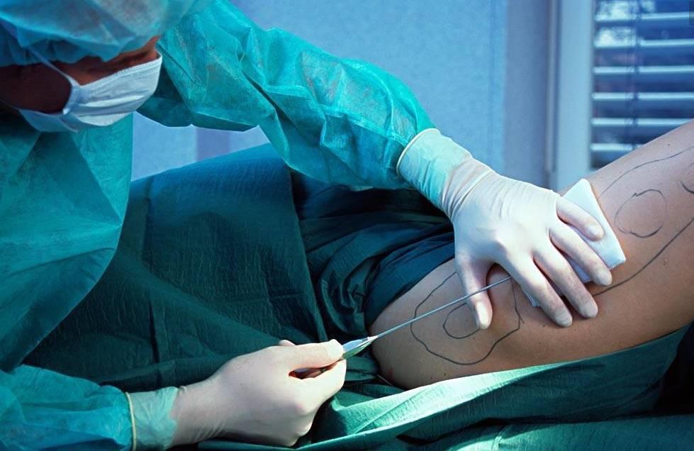 Số phận bi thảm của cô gái đầu tiên hút mỡ trong lịch sử-1