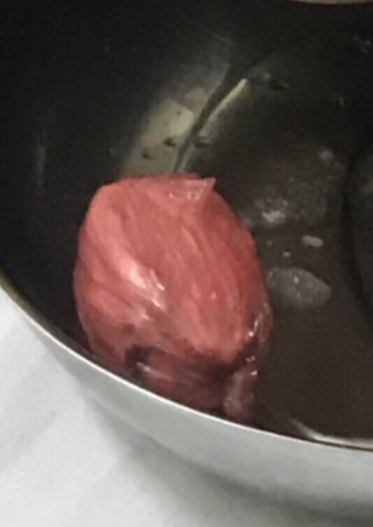 Chuyện khó tin: 12 giờ giải cứu cục ma túy giấu trong vùng kín-1