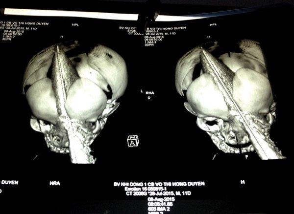 Cậu bé bị đâm xuyên sọ cách đây 3 năm giờ ra sao?-2