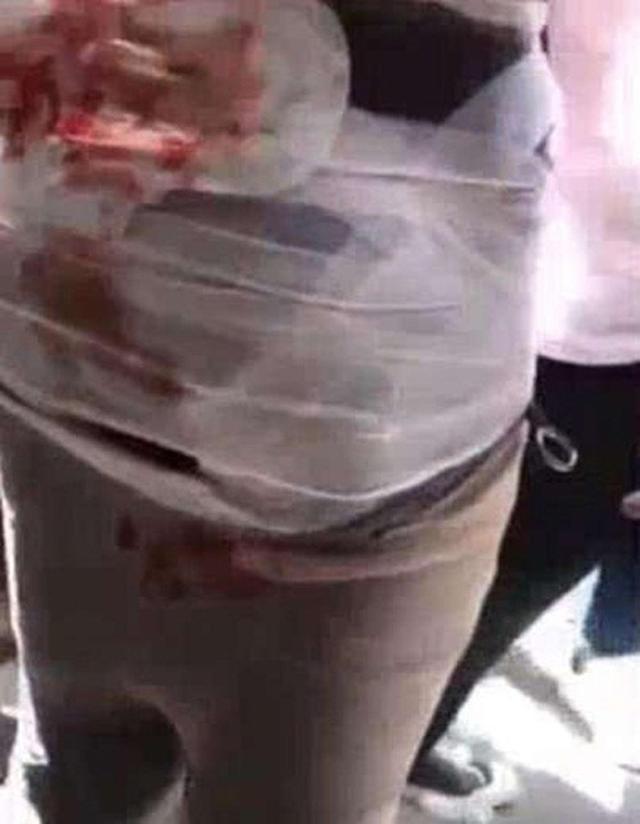 Chú rể trẻ bị thương nặng trong ngày cưới vì bị bạn bè dính pháo vào mông rồi châm lửa đốt-1