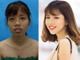 Từng có ý định tử tự vì bị ví 'Thị Nở thời hiện đại', cô gái đến từ Bắc Ninh quyết thẩm mỹ khiến người thân không nhận ra Từng có ý định tử tự vì bị ví 'Thị Nở thời hiện đại', cô gái đến từ Bắc Ninh quyết thẩm mỹ khiến người thân không nhận ra
