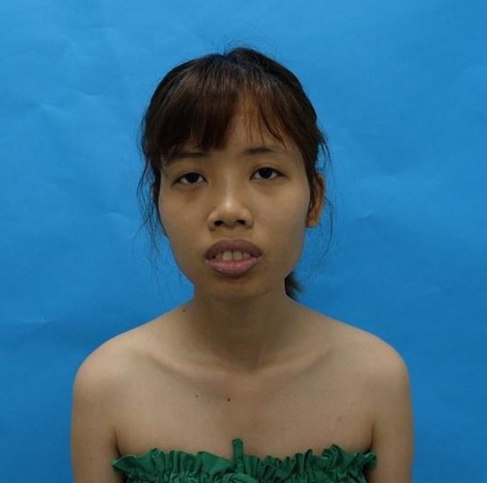 Từng có ý định tử tự vì bị ví Thị Nở thời hiện đại, cô gái đến từ Bắc Ninh quyết thẩm mỹ khiến người thân không nhận ra-2