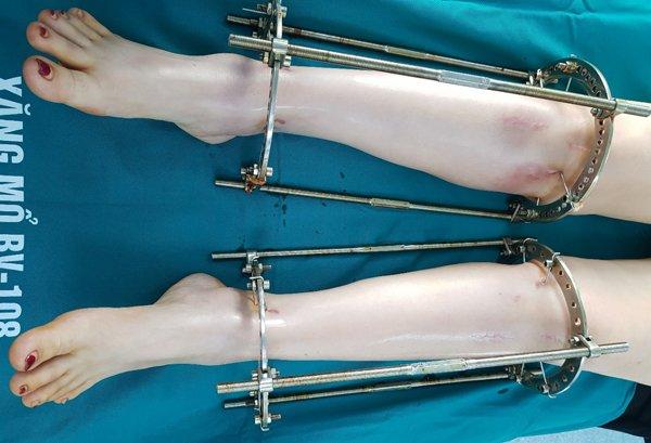 Bác sĩ kể ca kéo dài chân của cô gái Hà Nội cao 1m38-1