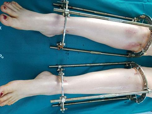 Có thể cao thêm tới 20cm, kéo dài chân đau cỡ nào?-4