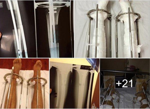 Có thể cao thêm tới 20cm, kéo dài chân đau cỡ nào?-2