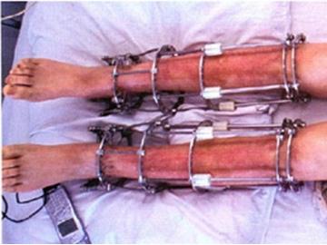 Có thể cao thêm tới 20cm, kéo dài chân đau cỡ nào?-5