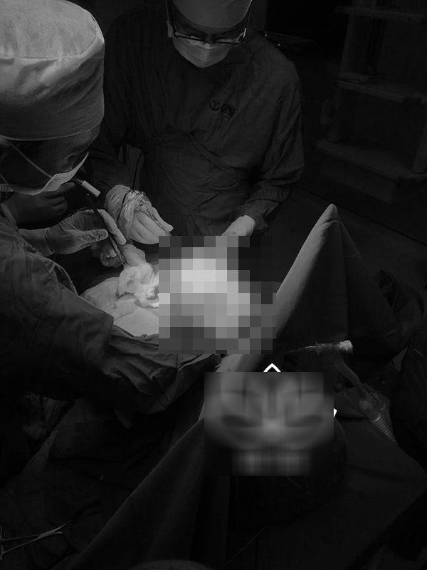 Cận cảnh quá trình phẫu thuật hút 2 kg mỡ trong ngực của nữ sinh ở Hải Dương, ai nhìn cũng shock-1