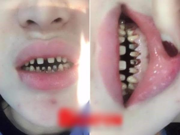 Bọc răng sứ - Bí quyết sở hữu nụ cười đẹp của giới trẻ-6