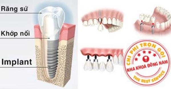 Hỗ trợ 20% chi phí trồng răng giả bằng Implant ETK Active-2
