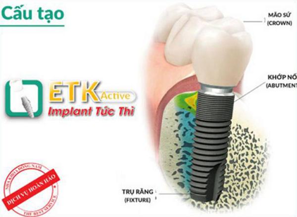 Hỗ trợ 20% chi phí trồng răng giả bằng Implant ETK Active-3