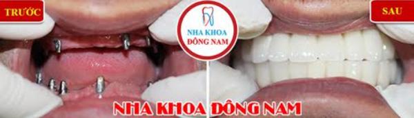 Hỗ trợ 20% chi phí trồng răng giả bằng Implant ETK Active-5