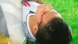 Máu chảy ròng ròng trên mắt, Quang Hải U23 an ủi người hâm mộ siêu lầy: 'Tôi vẫn khỏe và đẹp trai nhé'
