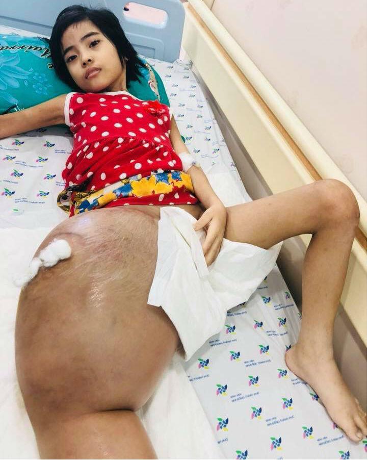 Tưởng con ngã gãy chân đơn giản, cha mẹ chết lặng khi bác sĩ nói con bị ung thư xương-1