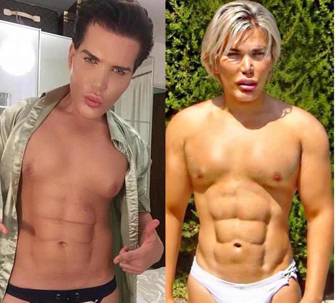 Gặp họa vì phẫu thuật cắt bỏ xương sườn để eo bé-3