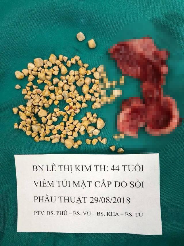 Túi mật hoại tử vì chứa gần 250 viên sỏi-1