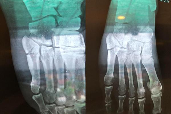 Bị chấn thương nặng ở chân, sao nhí Đội đặc nhiệm nhà C21 Hà Duy vui vẻ đón nhận vì đang gánh hạn làm nhà-1