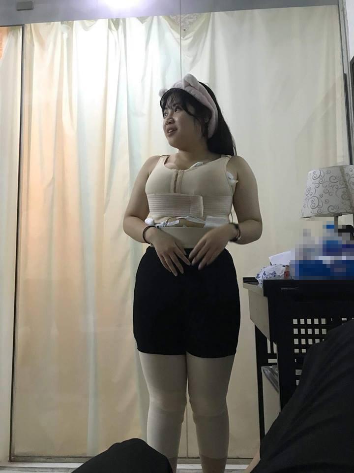 CÓ AI NGỜ: Nữ sinh Hải Dương gọn gàng khó tin sau cuộc đại phẫu rút 9 lít mỡ thừa ở ngực và bụng-1