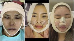 Những hình ảnh vẽ tạo hình, băng bó chằng chịt của sao Việt trên bàn phẫu thuật thẩm mỹ khiến người ta giật mình
