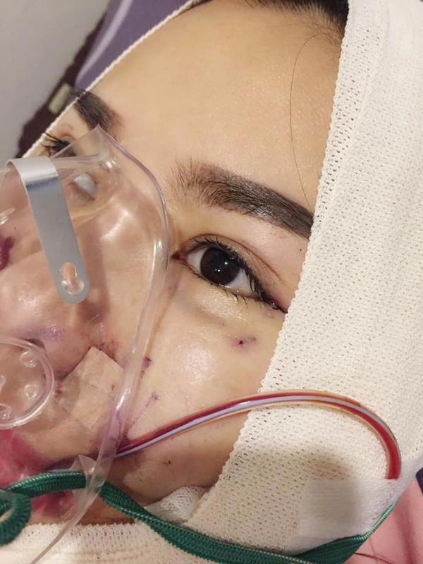 Những hình ảnh vẽ tạo hình, băng bó chằng chịt của sao Việt trên bàn phẫu thuật thẩm mỹ khiến người ta giật mình-4