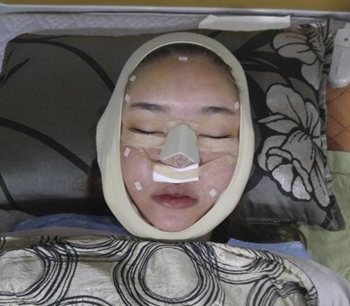 Những hình ảnh vẽ tạo hình, băng bó chằng chịt của sao Việt trên bàn phẫu thuật thẩm mỹ khiến người ta giật mình-7
