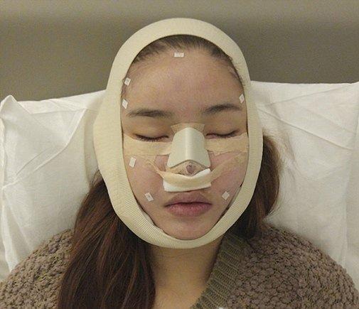 Những hình ảnh vẽ tạo hình, băng bó chằng chịt của sao Việt trên bàn phẫu thuật thẩm mỹ khiến người ta giật mình-8