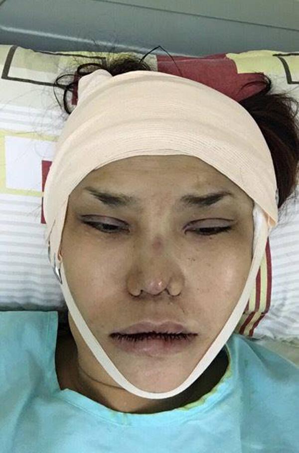 Những hình ảnh vẽ tạo hình, băng bó chằng chịt của sao Việt trên bàn phẫu thuật thẩm mỹ khiến người ta giật mình-14