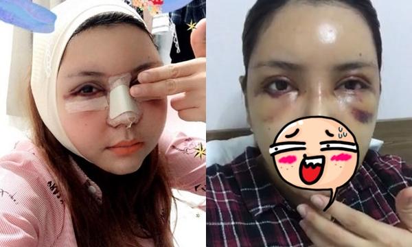 Những hình ảnh vẽ tạo hình, băng bó chằng chịt của sao Việt trên bàn phẫu thuật thẩm mỹ khiến người ta giật mình-21