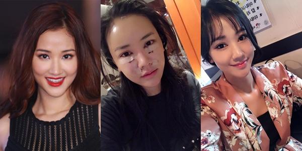 Những hình ảnh vẽ tạo hình, băng bó chằng chịt của sao Việt trên bàn phẫu thuật thẩm mỹ khiến người ta giật mình-20