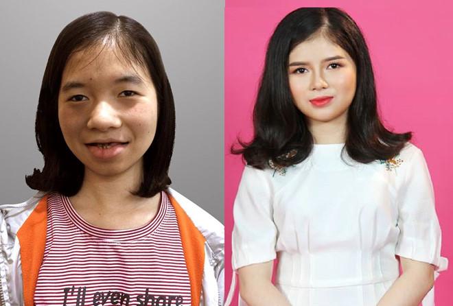 Cô gái bị chê là ma cà rồng lột xác sau 5 lần phẫu thuật thẩm mỹ-1