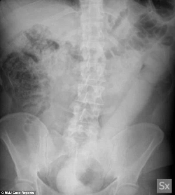 Thử cảm giác lạ bằng dương vật giả 60cm, người đàn ông khóc thét vì không thể rút ra-1