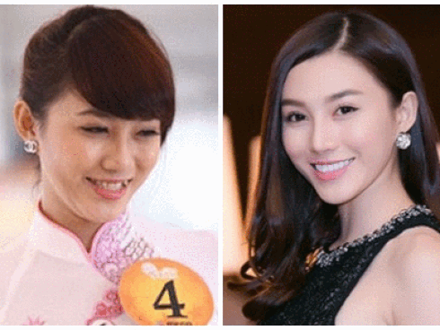 Chỉnh răng giống Cát Phượng và An Nguy, loạt sao Việt dung mạo thay đổi 'một bước lên hương'